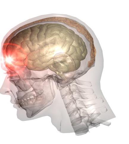 mtbi Symptoms Cognitive Reading comprehension difficulties Problem solving difficulties Lost easily Confusion Planning difficulties Easily