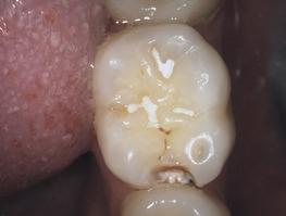 1) the caries is impossible to detect either with the naked eye or with a