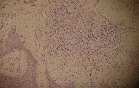 squamous cell carcinoma.