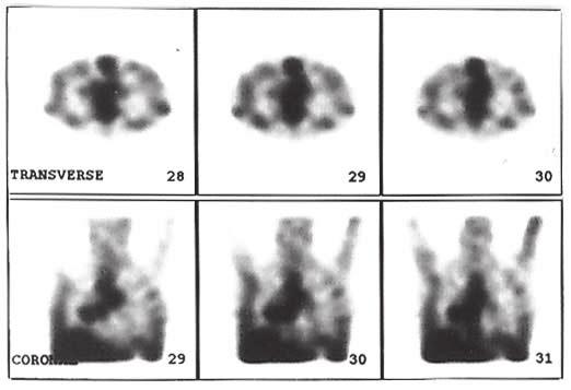 b: Ga-67 scan (top row: transverse, lower row: coronal views) taken 1 year after the initial scan, no axillary accumulation of Ga-67 was observed, but grade 2 bilateral symmetric lung hilar uptake