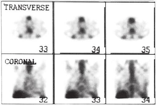 a Fig. 4 Thorax Ga-67 SPECT images (top row: transverse, lower row: coronal views) of a 67-year-old male with the diagnosis of HD (Patient no. 29).