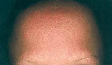 Figure 2. Vitamin D dependent rickets type IIA alopecia. Note the total absence of hair on the forehead and scalp except for the eyebrows, which show partial loss.