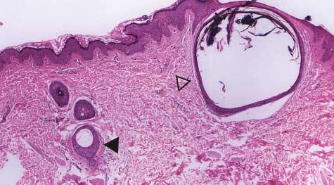 follicle (hematoxylin-eosin, original magnification 40). Figure 4. Alopecia associated with hairless gene mutations.