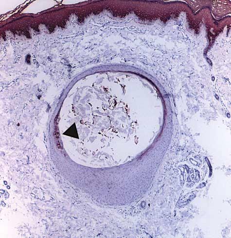 Figure 7. Vitamin D dependent rickets alopecia. A large keratinizing cyst is in the middle dermis.