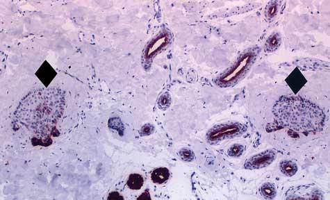 REFERENCES Figure 10. Immunostaining of the biopsy specimen shown in Figure 3.