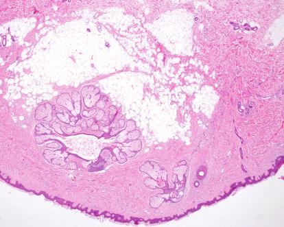histology of these nodules, we interpret this lesion as an NLS with FSCH and not as a giant FSCH. Our case 2 must be differentiated from a skin tag with fat cells and from a sebaceous TF.