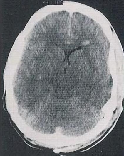 herniation normal brain