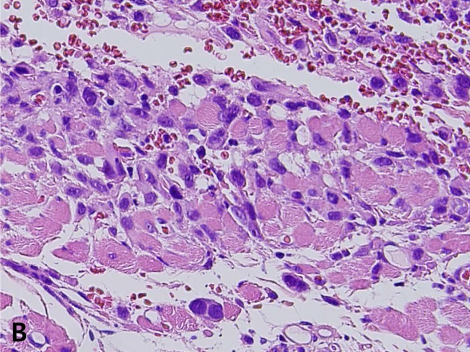 cells and many atypical mitoses ( 20/10 HPFs) (H&E, 400).