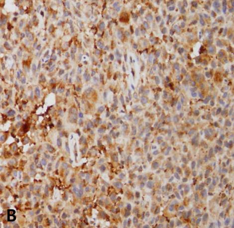 Immunohistochemical staining demonstrated that the tumor cells were