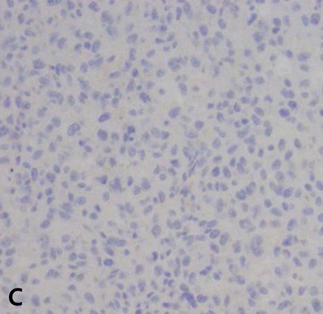 3B); weakly positive for smooth muscle actin (Fig.