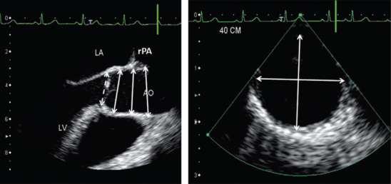 Permits assessment of the aortic valve, which is often involved in diseases of the ascending aorta Can look at