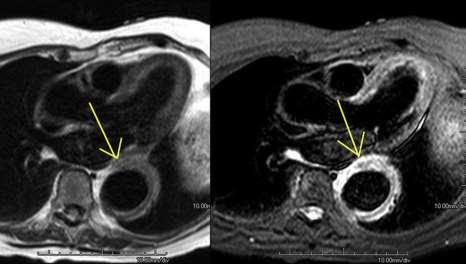 Non invasive imaging for diagnosis MRI: Maximal aortic diameter Involvement of aortic