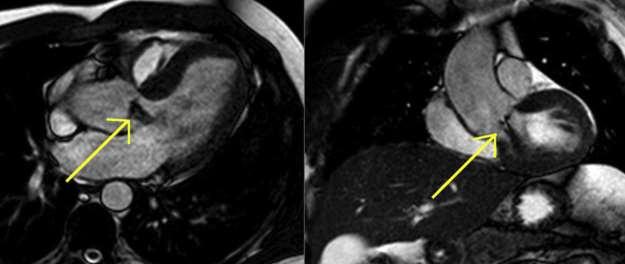 to show the intimal flap The disadvantage of MRI is the difficulty of evaluating aortic