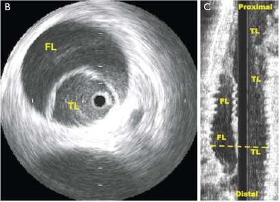 aneurysms Intravascular ultrasound: To optimize visualization