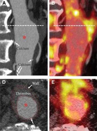 Non invasive imaging for diagnosis Positron emission tomography: To detect: