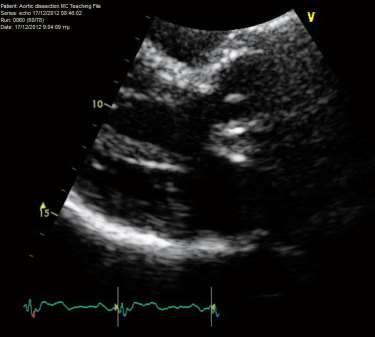 Case 4 Reason for study (17-12-2012) AVR AND AORTIC ROOT
