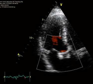 Normal right ventricle with impaired function. TAPSE = 1.30 cm.