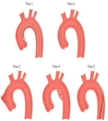 Introduction Aortic