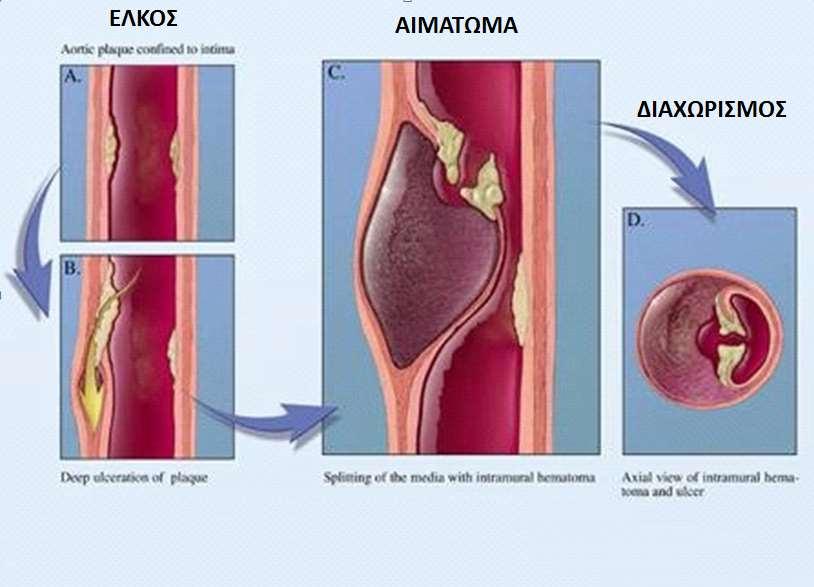 hematoma Penetrating
