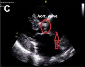 aortic root with an image compatible with a