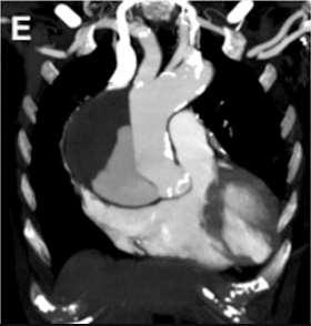 Case 2 Thoracic angio-ct : extension of the aortic dissection from