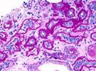 Solidified and disappearing glomerulosclerosis Thyroidization-type tubular atrophy