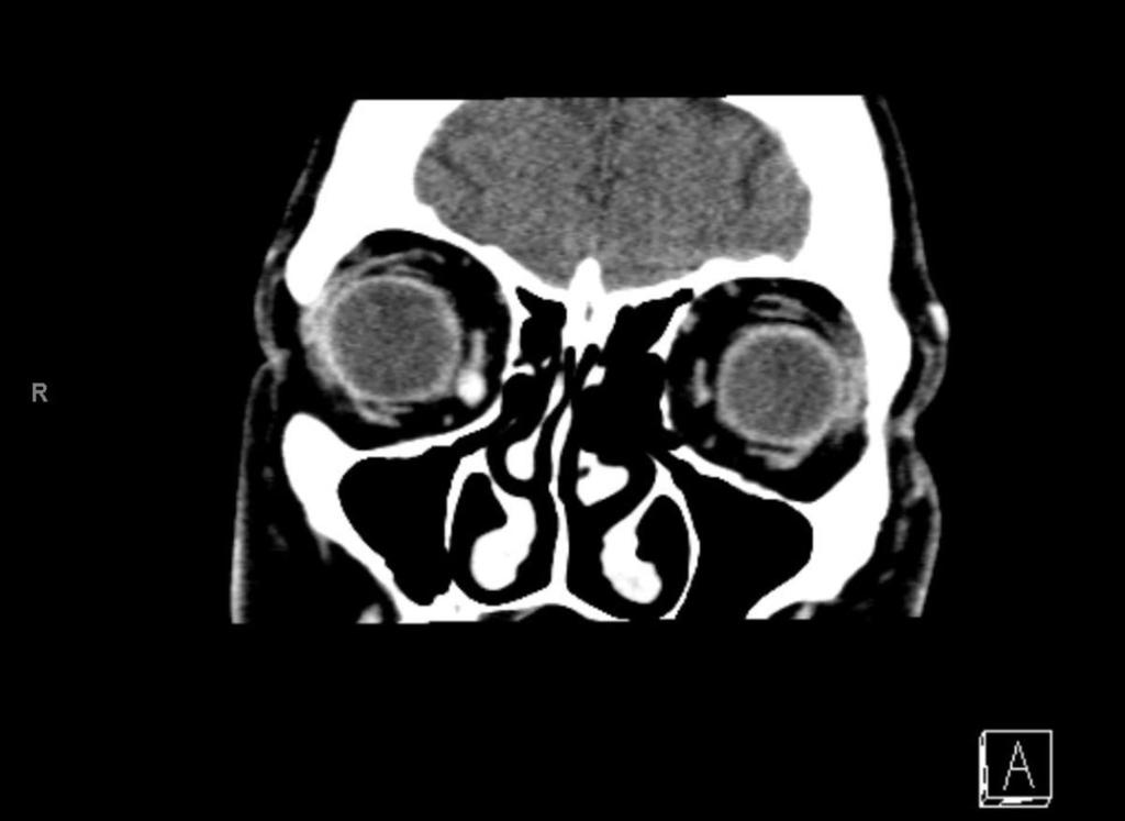 Fig. 2: Coronal image of the orbita showing a well