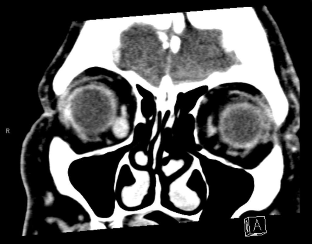 Fig. 3: Coronal image in prone position with increased