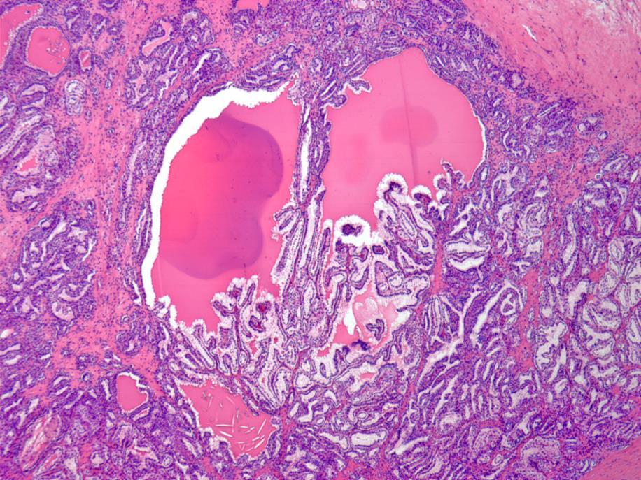 Clear cell papillary renal cell carcinoma Tubulopapillary