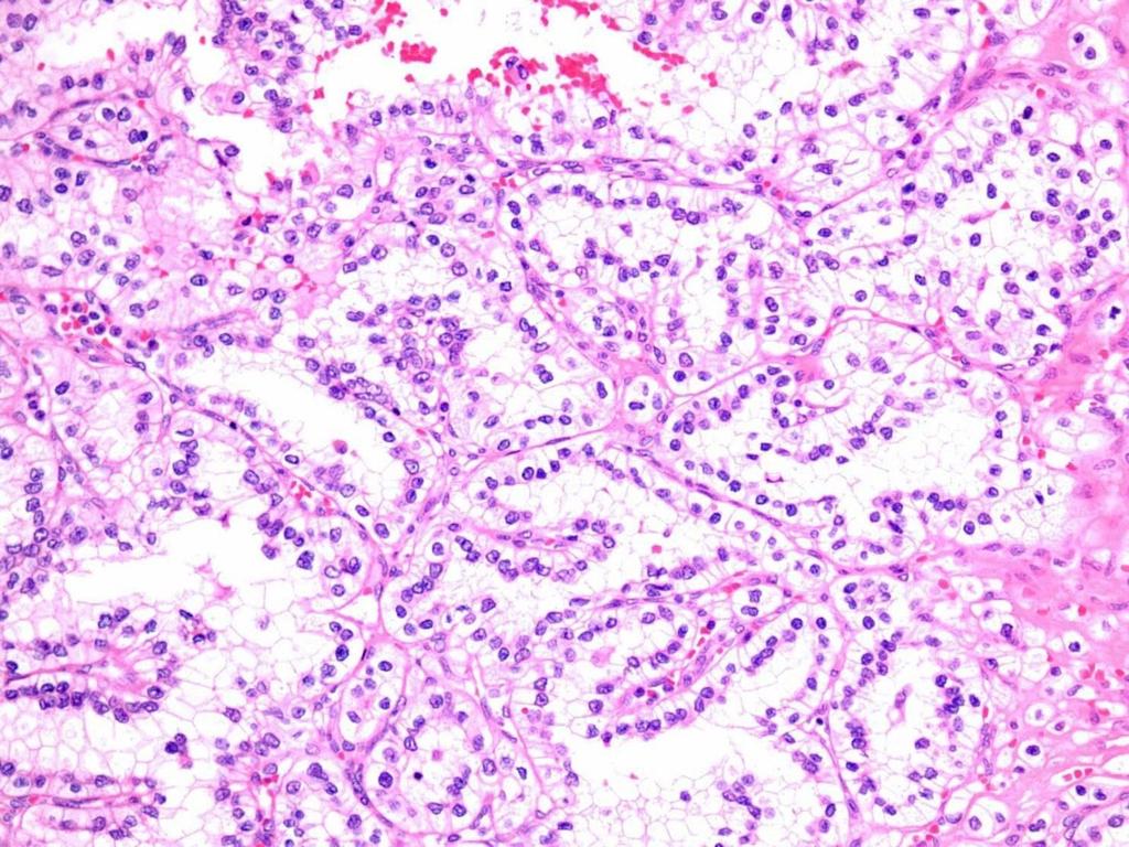 Clear cell papillary renal cell carcinoma Linear arrangement of nuclei