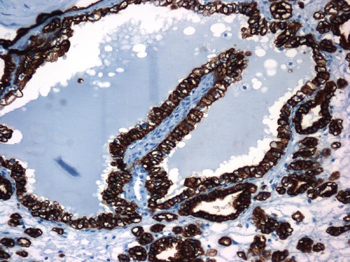 Clear cell papillary renal cell carcinoma IHC and cytogenetic profile: CK7,