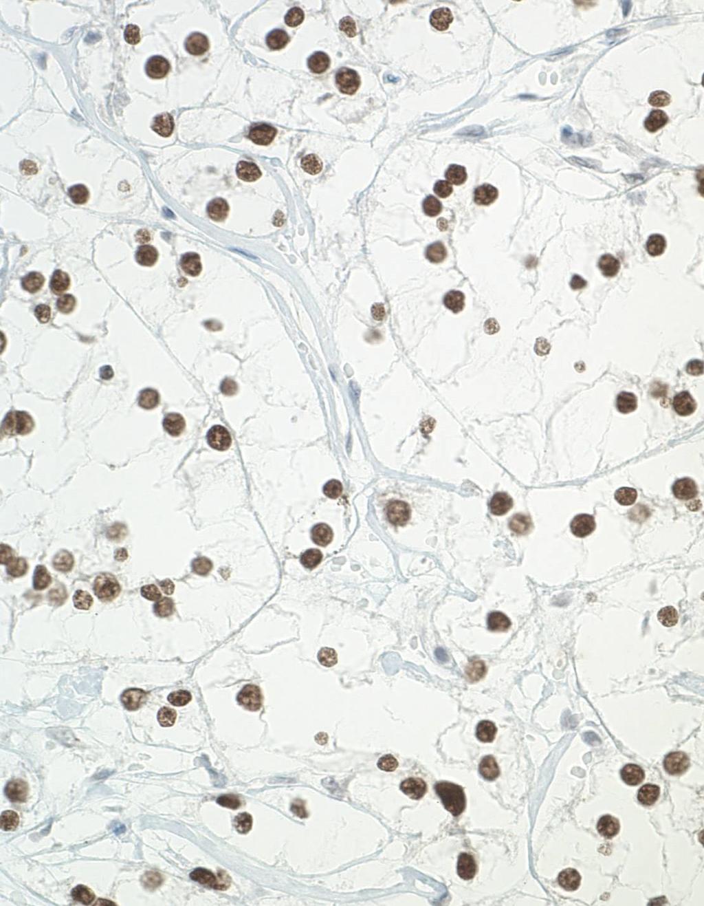 Xp11 translocation renal cell carcinoma IHC and cytogenetic profile: Vimentin, CD10, RCC + CK7 - Pan-CK, AE1/3, CAM5.