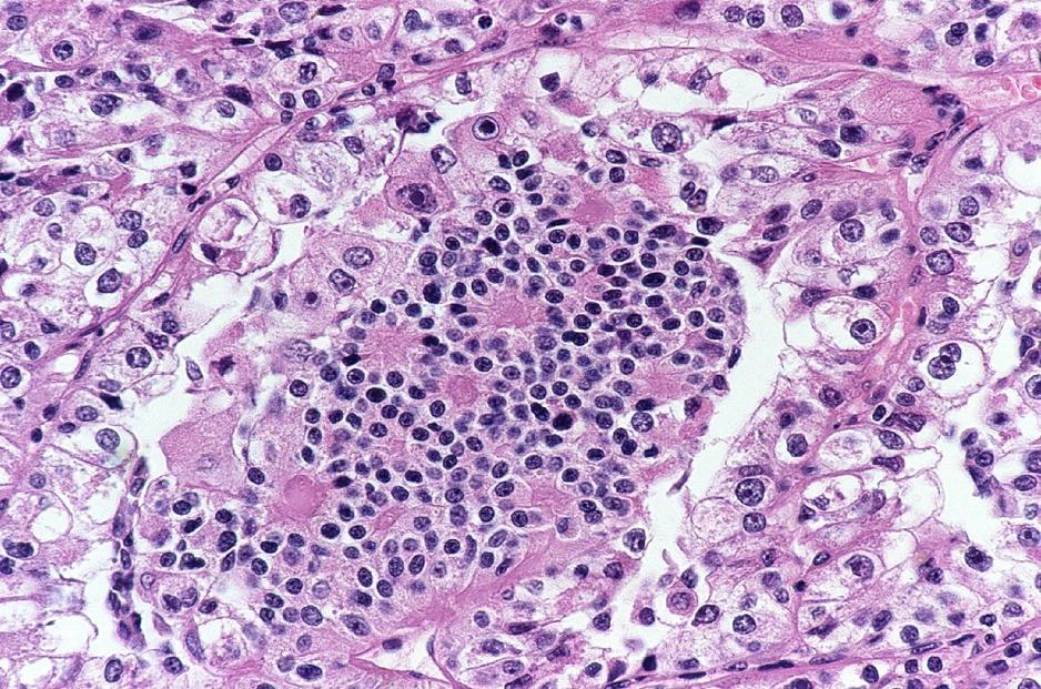 t(6;11) renal cell