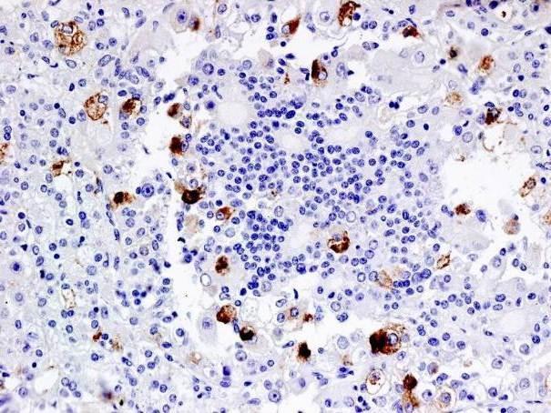t(6;11) renal cell carcinoma IHC profile: HMB45+, Melan A+ Mostly