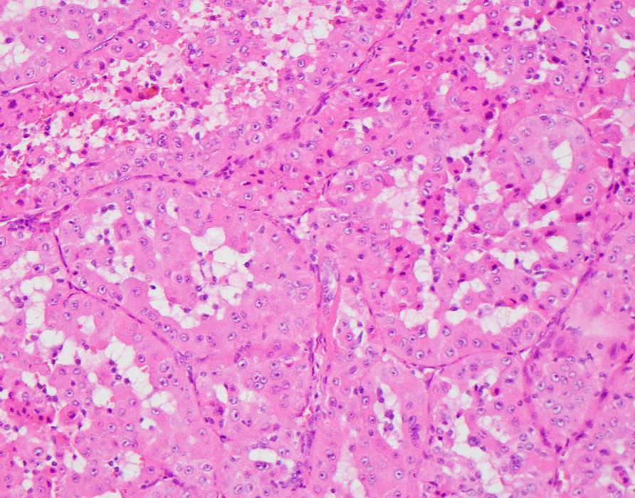 TFEB amplified renal cell carcinoma Emerging entity Most cases show