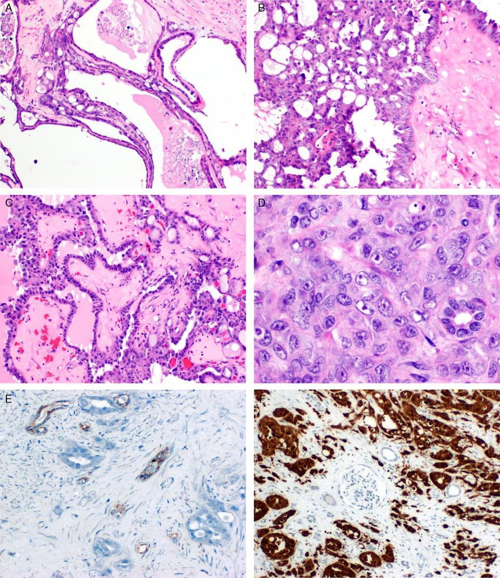 Tubulocystic carcinoma with poorly differentiated
