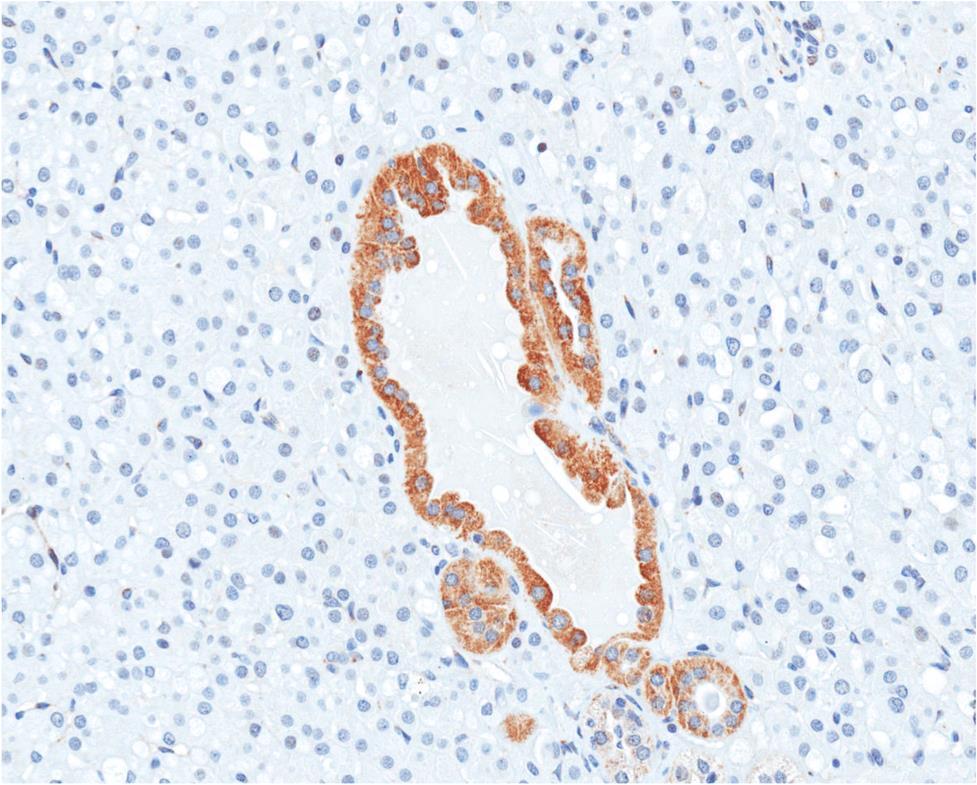 Succinate Dehydrogenase (SDH) Deficient - RCC: IHC and differential diagnosis SDH-deficient RCC SDHB PAX-8 EMA CD10 CK20 CK7 CD117 - + + + - - - * *stains intratumoral mast cells