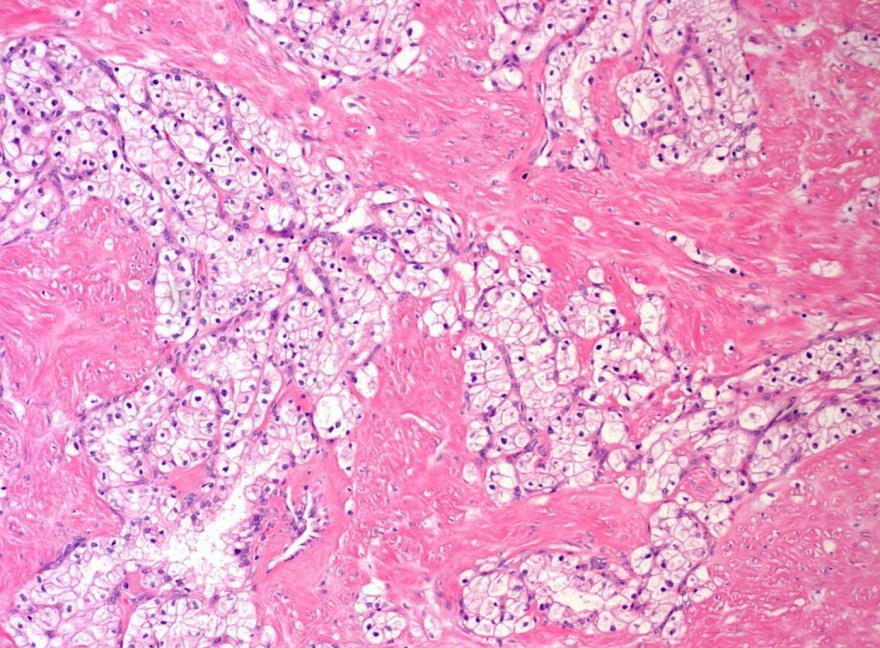 Renal cell carcinoma associated with prominent angio(leiomyomatous) stroma Renal angiomyoadenomatous