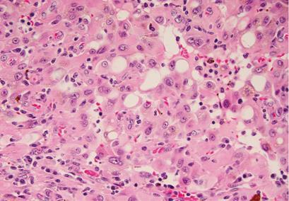 morphology: polygonal to spindle cells with abundant eosinophilic cytoplasm and frequent intracytoplasmic