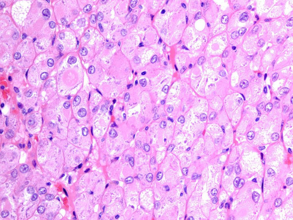 Eosinophilic, Solid, and Cystic Renal