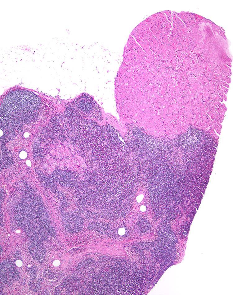 Eosinophilic solid and cystic renal cell carcinomas have metastatic potential Li Y et al. Histopathology 2018; McKenney J et al.
