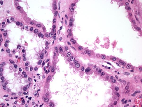 Tubulocystic Renal Cell Carcinoma IHC and cytogenetic profile:
