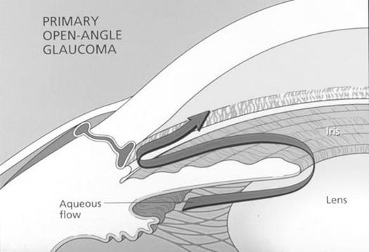 Types of Glaucoma Open Angle