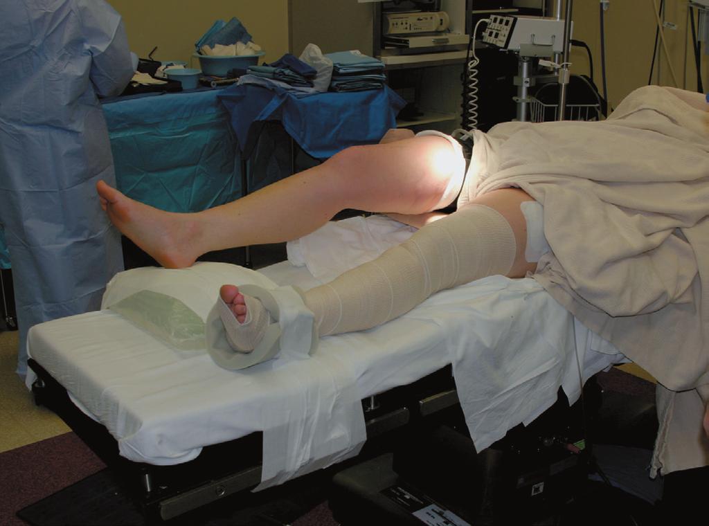 CHAPTER 51 ARTHROSCOPY OF THE LOWER EXTREMITY 2395 FIGURE 51-3 Placement of lateral post and taping of saline bag to table allow ease of leg positioning and full range of motion during ligament