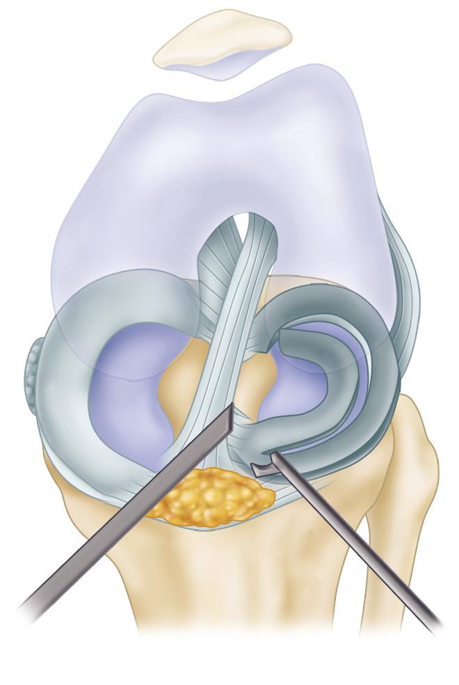 2404 PART XIV ARTHROSCOPY A B C D FIGURE 51-17 Two-portal technique for bucket-handle tears of lateral meniscus. A, Displaced bucket-handle tear of lateral meniscus probed.
