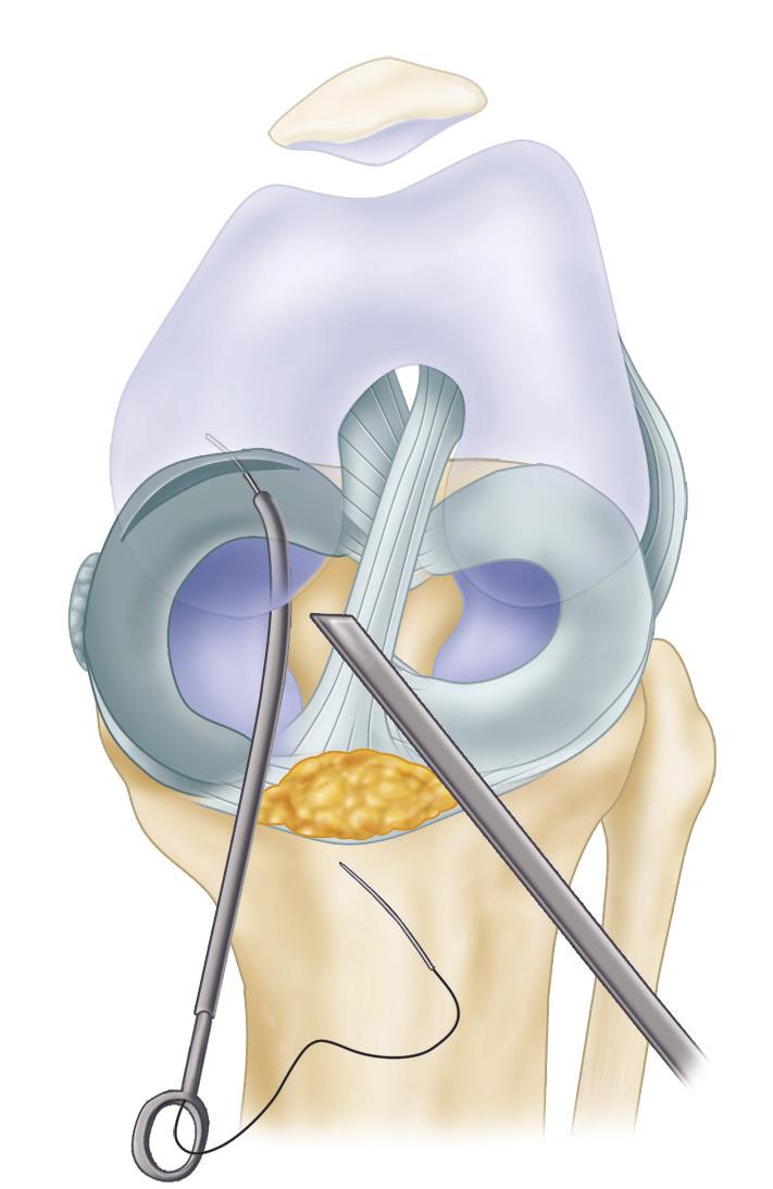 2410 PART XIV ARTHROSCOPY A B FIGURE 51-23 A, Most posterior sutures are placed with cannula in ipsilateral portal.