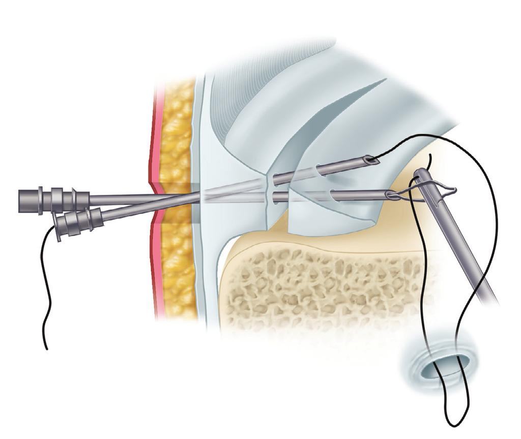 A For large peripheral lesions on the medial side, such as a displaced peripheral bucket-handle tear, a combination of inside-to-outside and outside-to-inside methods can be used.