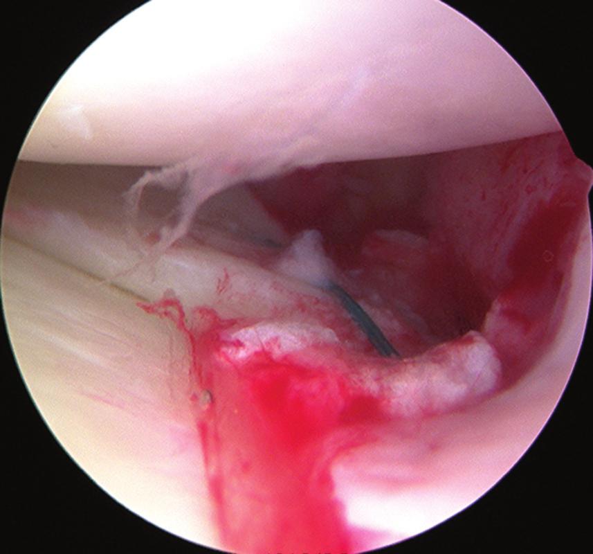 CHAPTER 51 ARTHROSCOPY OF THE LOWER EXTREMITY 2413 posterolaterally.