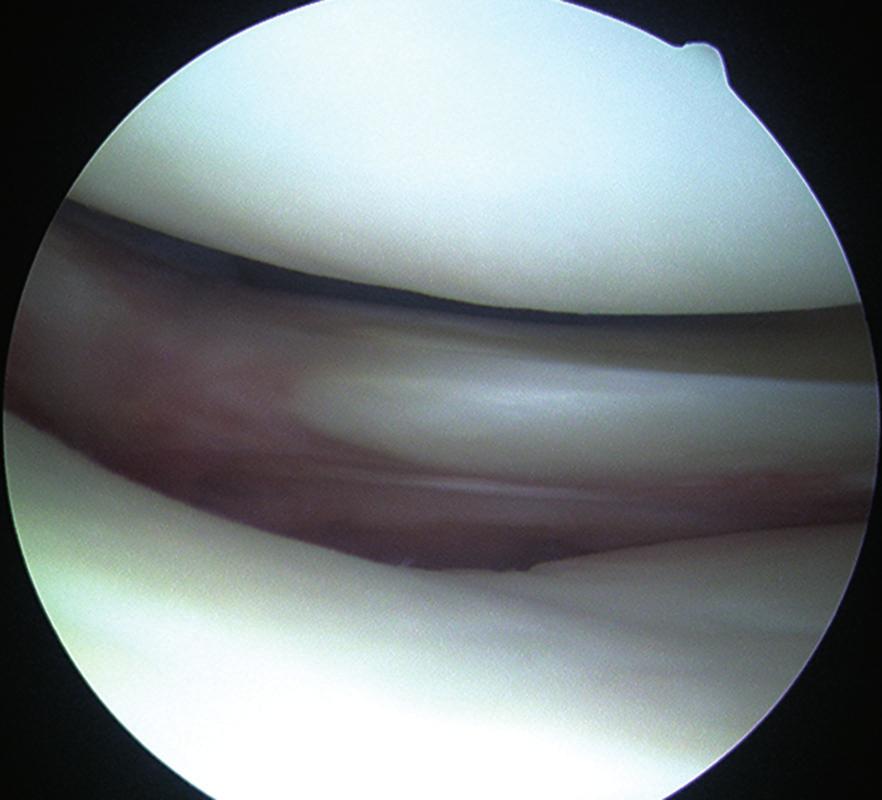 2400 PART XIV ARTHROSCOPY B A C FIGURE 51-13 Types of meniscal excision: partial meniscectomy (A); subtotal meniscectomy (B); and total meniscectomy (C).