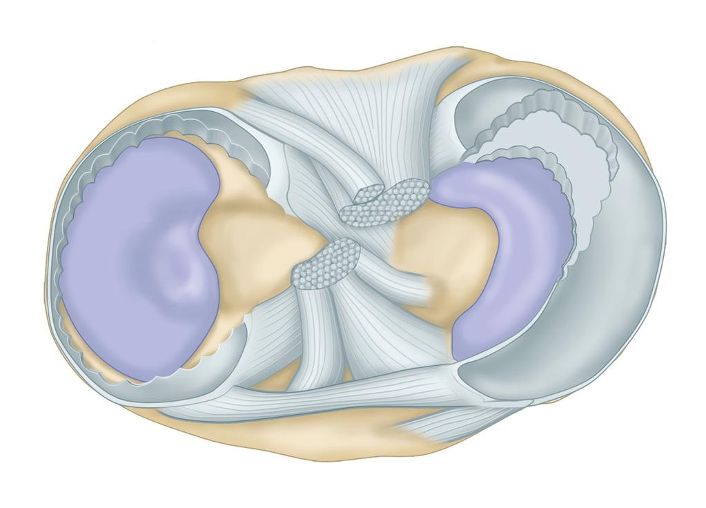 The possible variations include flap tears, complex tears, and degenerative meniscal tears.